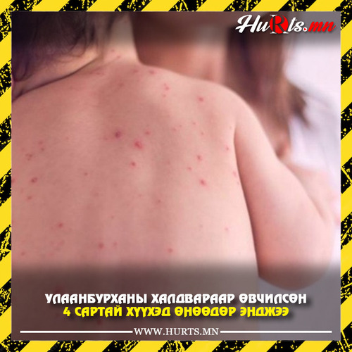 ХӨСҮТ: Улаанбурхан өвчний халдвараар оношлогдсон дөрвөн сартай нярай өнөөдөр эндлээ